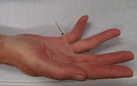 Maybe you would like to learn more about one of these? Dupuytren S Contracture Wikipedia