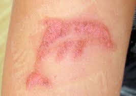 Image result for dermatitis contacta