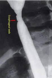 In case of significant obstruction of the esophageal lumen by esophageal web and persistent. Plummer Vinson Syndrome In A Male And His Chromosomal Study A Case Report Sciencedirect