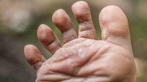 Although this recipe says to bake in the oven, this can easily be done over the fire or grill. Scaling Skin Pictures Causes Diagnosis And Treatment