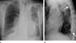 Image result for Pleural Tuberculosis
