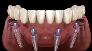 Image result for dental implant
