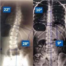 Curvas de até 30 graus são tratadas conservadoramente com exercícios específicos de fisioterapia e especialmente por meio da rpg (reeducação postural global). Coletes Ortopedicos 3d Para Escoliose 19 98143 0974 Whatsapp