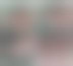 Image result for toe amputation