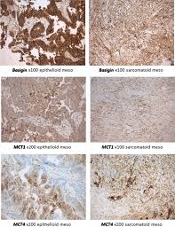 Mpm is classified by the world health organization into three major histologic subtypes: Tissue Expression Of Lactate Transporters Mct1 And Mct4 And Prognosis Of Malignant Pleural Mesothelioma Brief Report Springerlink