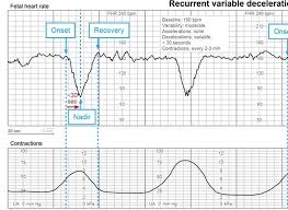 Image result for Variable Deceleration