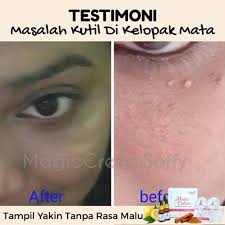 Biarkan selama 15 hingga 20 minit dan kemudian cuci muka dengan. Magicsoffy Hilangkan Kutil Kolestrol Di Wajah Shopee Malaysia