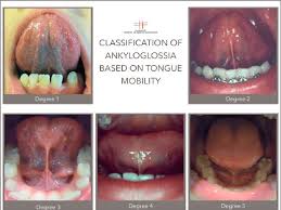 Image result for Ankyloglossia