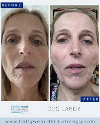 ✨ CO₂ Laser Results ✨ Smoother, tighter, and more radiant skin is possible!  🌟 This patient's transformation showcases the power of the CO₂ laser,  expertly performed by Dr. Eduardo Weiss. This advanced