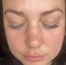 Sunless sunburn rash with autoimmune disease and alopecia symptoms?