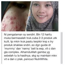 Oleh itu, semua produk suntikan kecantikan tidak diluluskan oleh kkm kecuali suntikan botox yang mempunyi indikasi lain. Bahaya Suntikan Vitamin C Qiya Beauty