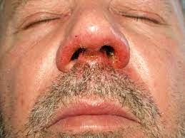 Datei Impetigo Nase Jpg Wikipedia