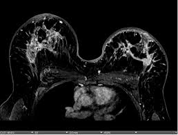 Image result for Inflammatory breast cancer