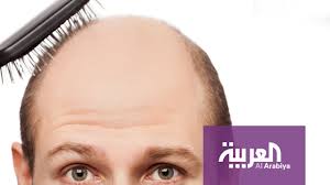 صباح العربية الخلايا الجذعية علاج لتساقط الشعر والصلع Youtube