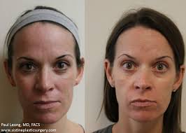 Before After Cortex Co2 Erbium Yag Laser Skin Resurfacing Dr Leong Sistine Plastic Surgery Pittsb Facial Plastic Laser Skin Resurfacing Skin Resurfacing