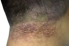 Image result for folliculitis symptoms