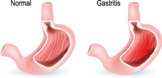 Magenschleimhautentzundung Gastritis Ursachen Symptome Behandlung Medlexi De