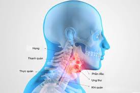 Trong các bệnh ung thư ở vùng tai mũi họng thì ung thư hạ họng đứng thứ 2, chỉ xếp sau ung thư vòm họng. Táº§m Soat Phat Hiá»‡n Sá»›m Ung ThÆ° Vom Há»ng Háº¡ Há»ng Thanh Quáº£n Trung Tam Nhi Tai MÅ©i Há»ng Ä'á»©c Phuc