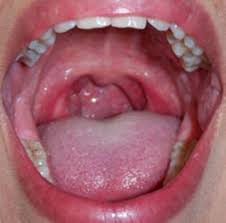 If you or someone you love is at risk for lung cancer, here's what you need to. Cancer Of Larynx Throat Cancer Risk Factors Symptoms Diagnosis Treatment Medindia Medindia Health Site