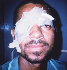 Right eye destroyed by a landmine. MOZAMBIQUE.