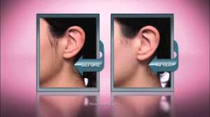 nono hair removal system uphairstyle