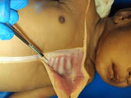 Image result for Neonatal Circumcision
