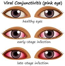 Image result for Viral Conjunctivitis