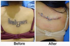 They offered a relatively low price and. Tattoo Removal Surgery In Bangalore Dr Shetty S Clinic Bangalore