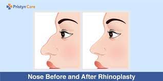 May 22, 2020 · smelly mucus in the nose, especially when it thickens and seems to drip incessantly down the back of your throat, is a sign of postnasal drip. Nose Before And After Rhinoplasty Pristyn Care