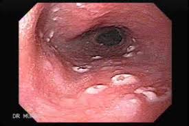 Image result for Candidiasis