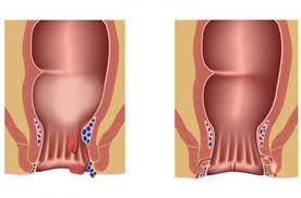 Haemorriden.net » expertenrat hämorrhoiden | expertenfrage. Proktologie Chirurgicum Berlin