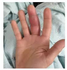 Image result for Hand Infection
