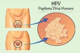 A vacina contra hpv é considerada muito segura. Hpv Sintomas Transmissao Cura E Tratamento Tua Saude