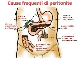 Appendicite con la peritonite acuta può essere generalizzata o localizzata. Classificazione Delle Peritoniti Acute