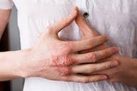 Decouvrez Medicament Egzema Ou Savon A L Huile D Olive Eczema Avec Des Plantes Idhd