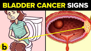 What are the symptoms of bladder cancer? 5 Early Signs Of Bladder Cancer Mostly Ignored By People Youtube