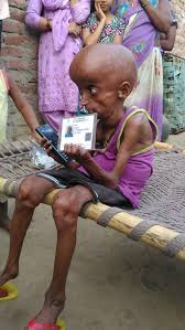 Meet Real Life Benjamin Button As Three Stone Man 21 Is Living In The Body Of A 160 Year Old World News Mirror Online