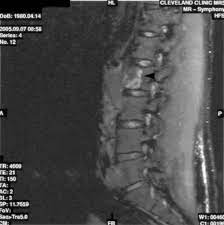 Nonseminomatous Germ Cell Tumor After Chemotherapy With Residual Mass Invading The Spine European Urology