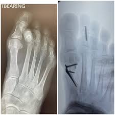 Image result for Toe Fracture