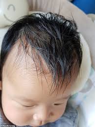 #aloevera #moringa #dandruffget rid of dandruff, get rid of. Baby With Cradle Cap Was Shedding Skin Like A Snake Daily Mail Online