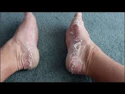 Read about possible causes of peeling skin and what you can do about it. Watch Skin Being Peeled Off Of Feet After Treatment Youtube