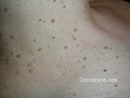 Las Verrugas Del Cuello No Son Verrugas Sino Fibromas Blandos Cuaderno En Piel