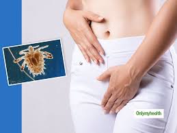 Image result for pubic lice symptoms