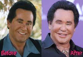 Full article · prev image next image. Wayne Newton Plastic Surgery A Las Vegas Facelift