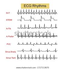 Is the qrs wide (> 0.12 seconds) 2. Shutterstock Puzzlepix