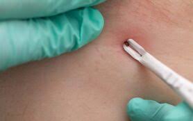 Image result for spinne biss haut reaktion