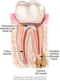 Making the procedure's access cavity. Root Canal Retreatment Dear Doctor Dentistry Oral Health