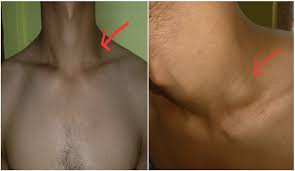 In patients over 40 years of age, it occurs in 9 out of 10 cases. Asymptomatic Isolated Cervical Tubercular Lymphadenopathy How To Proceed A Case Series Asian Journal Of Medical Research