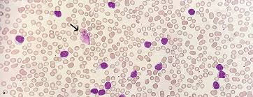 Chronische Lymphatische Leukamie Neue Behandlungsstrategien Swiss Medical Forum