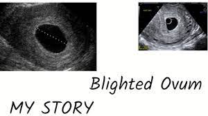 In an anembryonic pregnancy or blighted ovum pregnancy, the sac develops, however, there is no foetus inside. My Story Mistakenly Got Diagnosed With Blighted Ovum Youtube